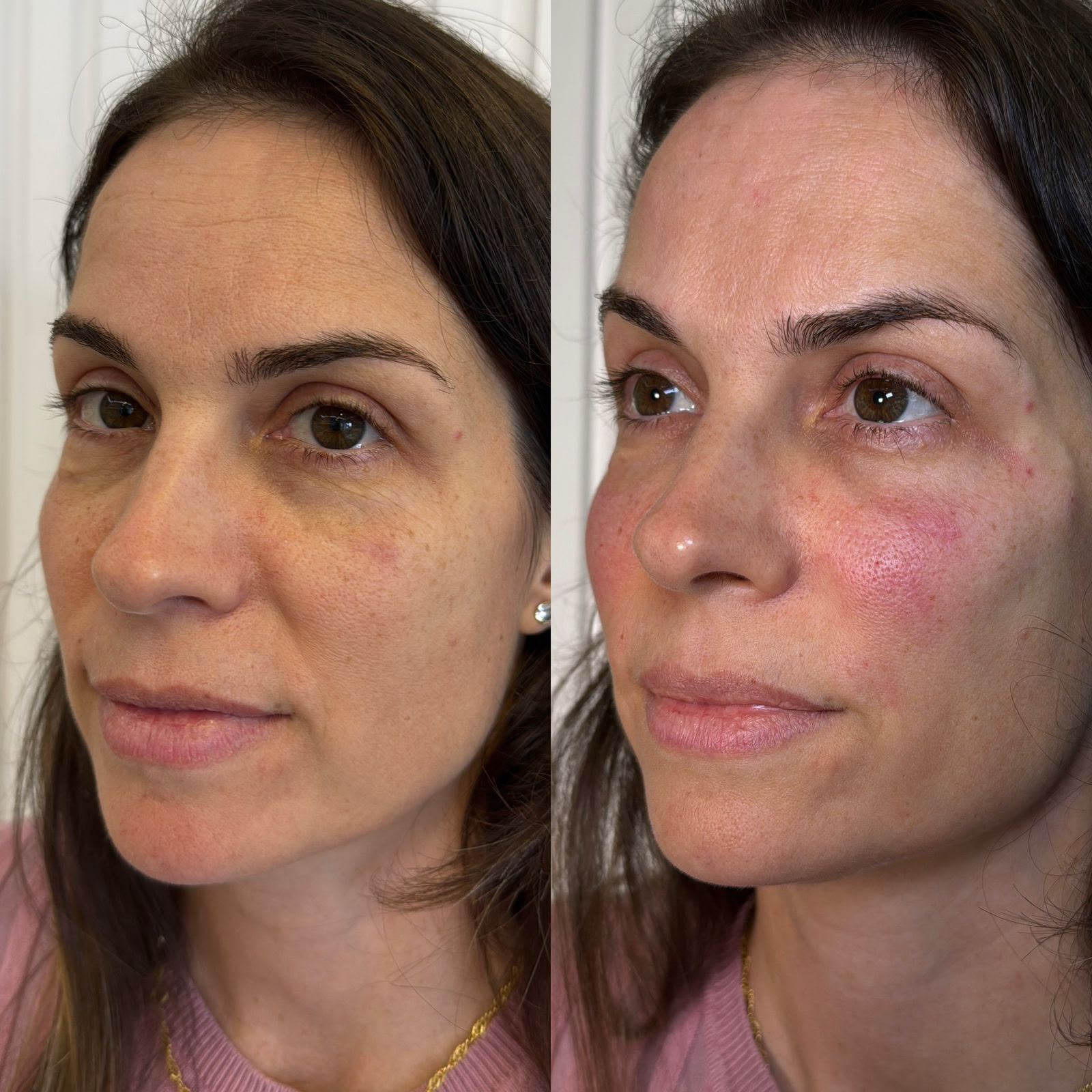 Antes e depois — rejuvenescimento facial