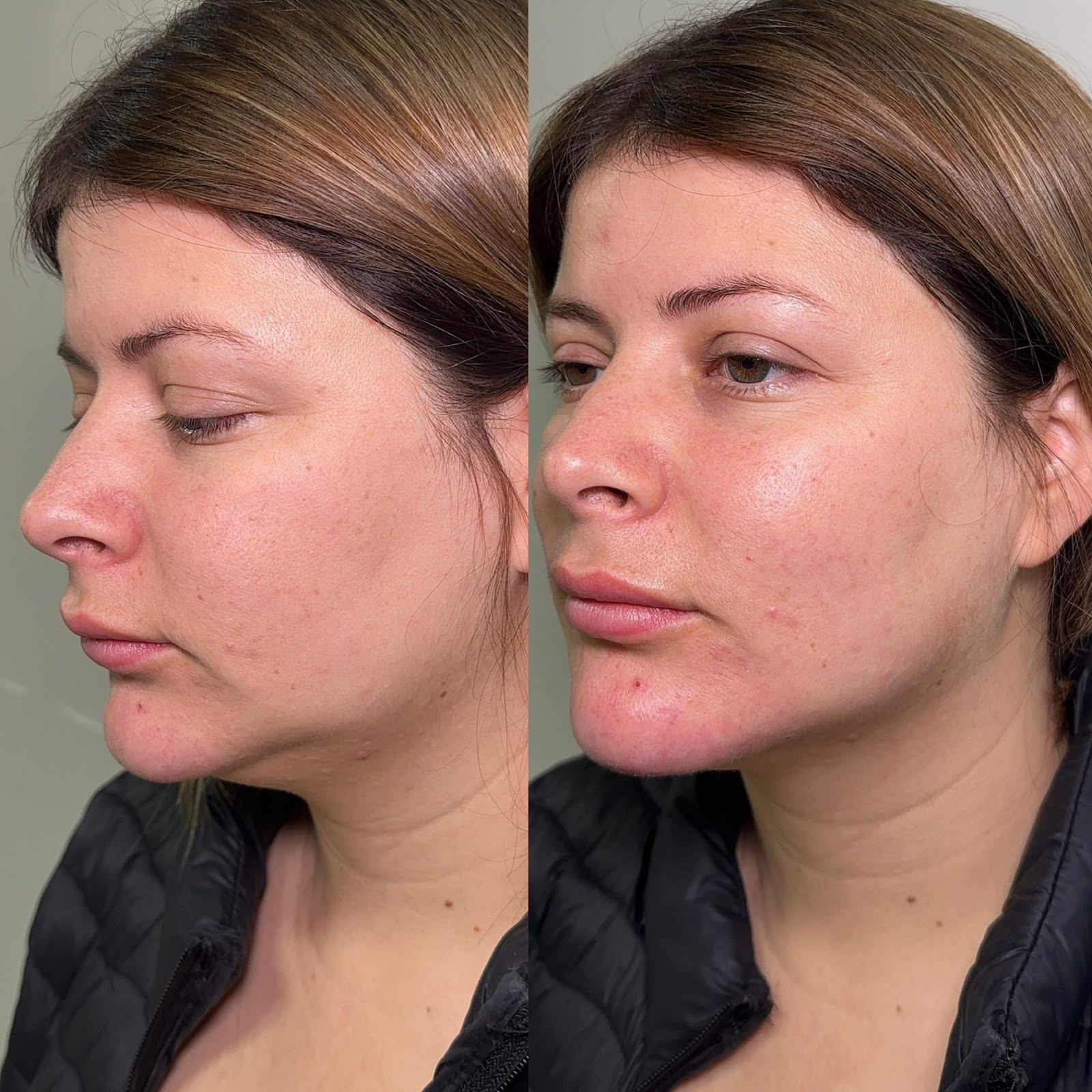 Antes e depois — harmonização de contorno