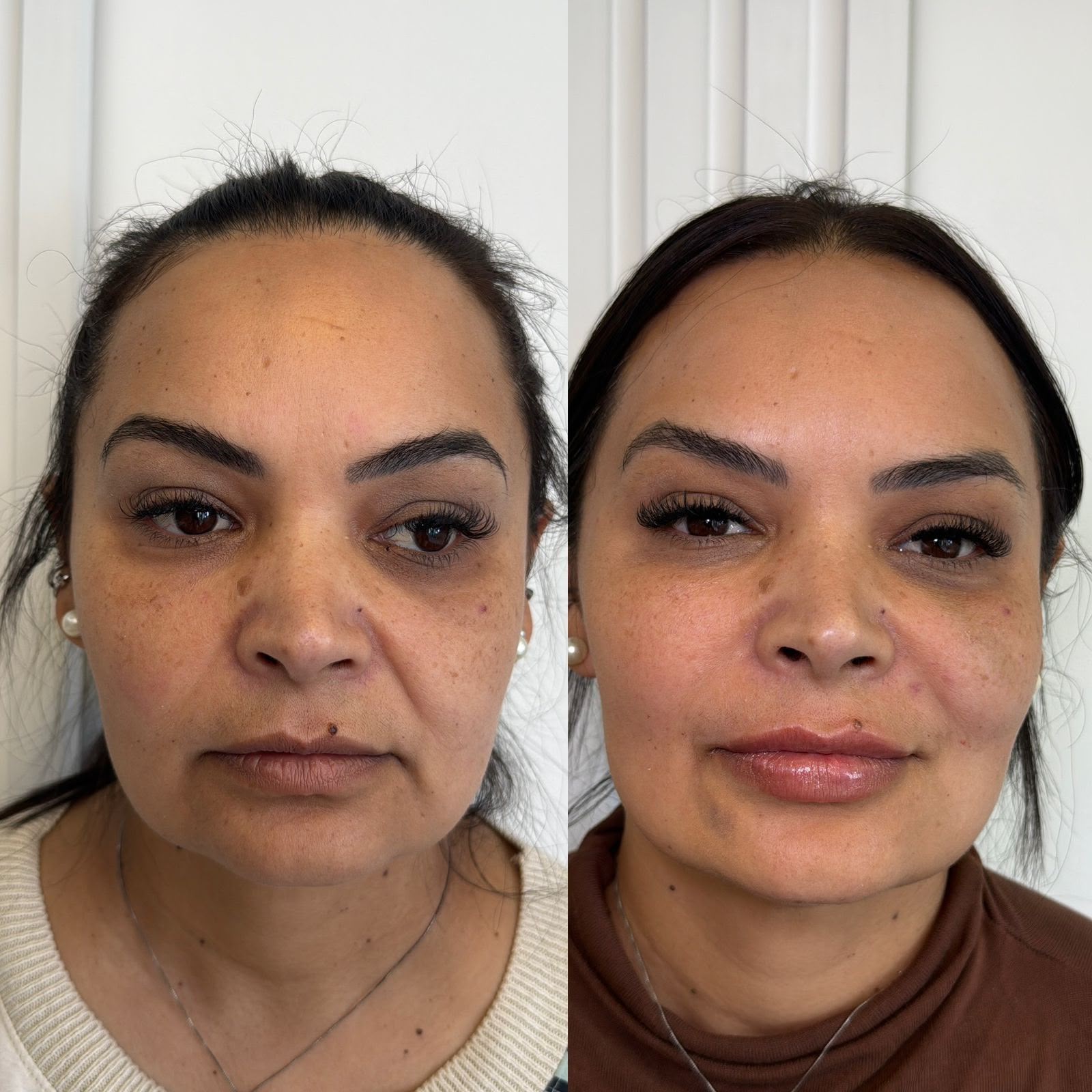 Antes e depois — harmonização facial completa