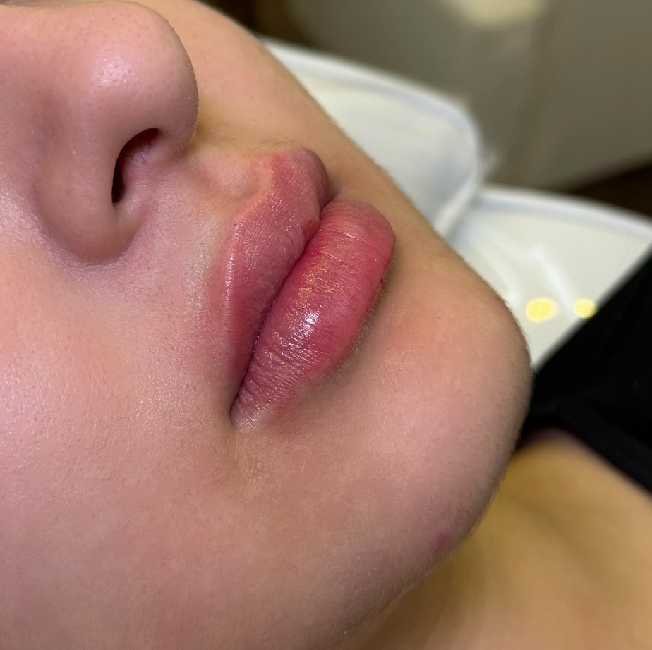 Trabalho — preenchimento labial