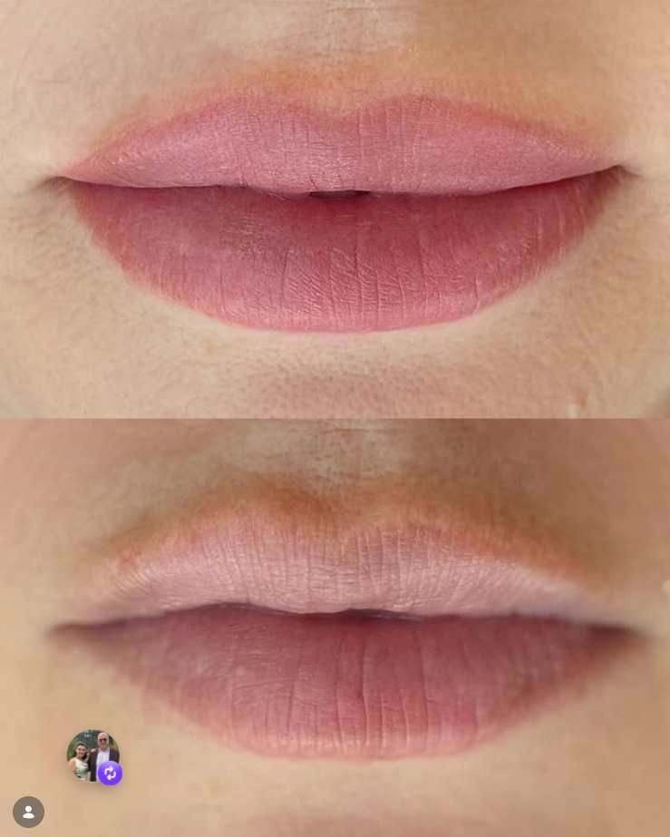 Antes e depois — preenchimento labial