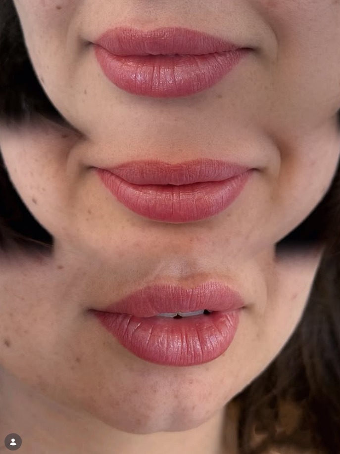 Antes e depois — preenchimento labial