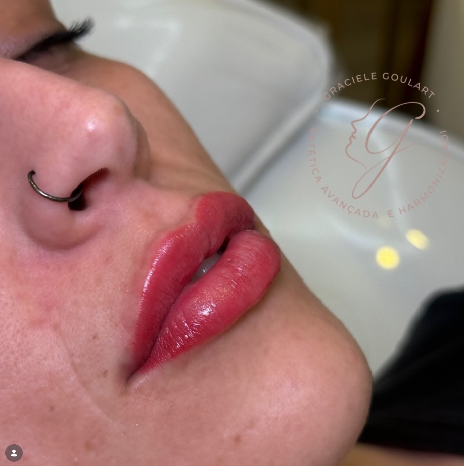 Trabalho — preenchimento labial