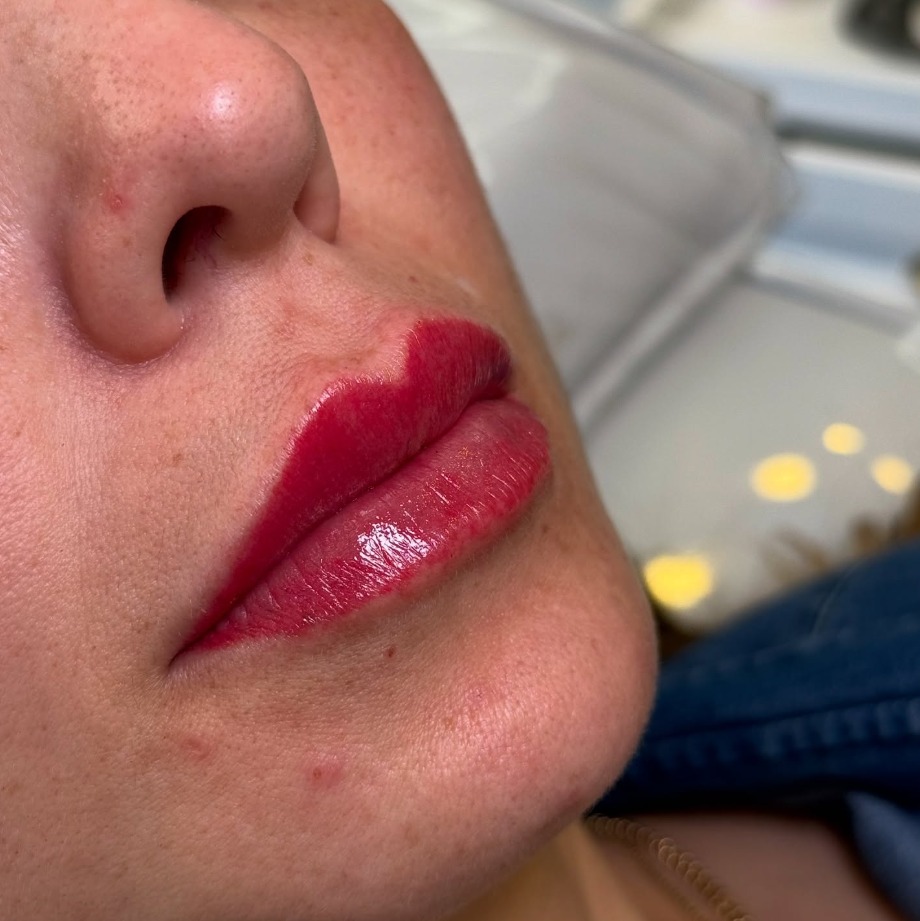 Trabalho — preenchimento labial