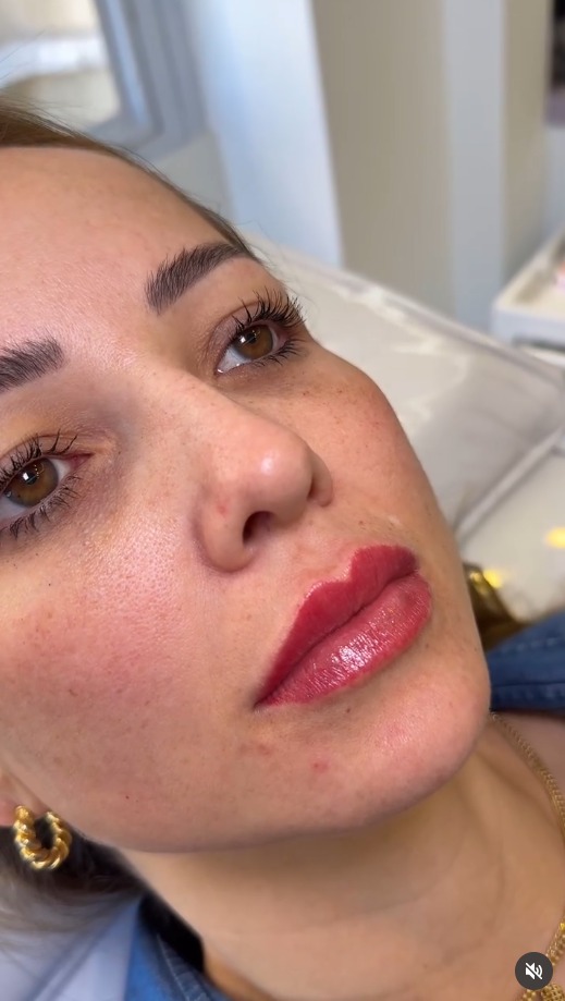 Trabalho — preenchimento labial