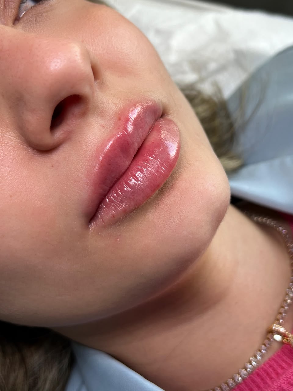 Trabalho — preenchimento labial