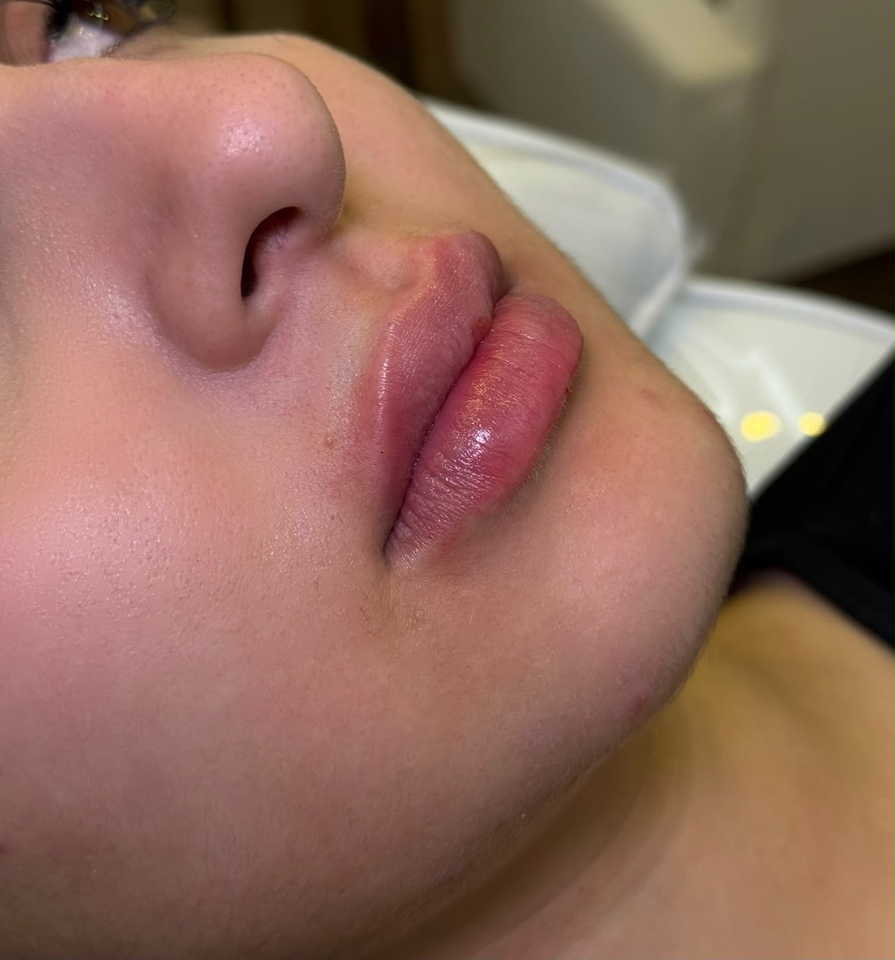 Trabalho — preenchimento labial