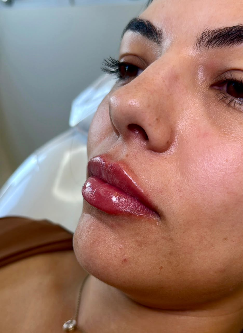 Trabalho — preenchimento labial